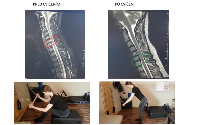 rezultat Pilates pentru spate